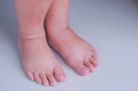 Common Reasons Behind Foot Swelling