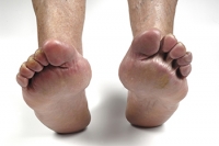 Rheumatoid Arthritis of the Feet and Ankles