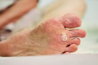Plantar Warts Can Have Black Dots in the Center
