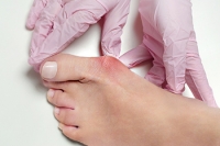 Causes of Bunions May Be More Than Just Footwear